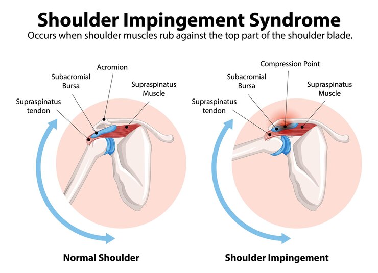 Shoulder-Impingement-Syndrome