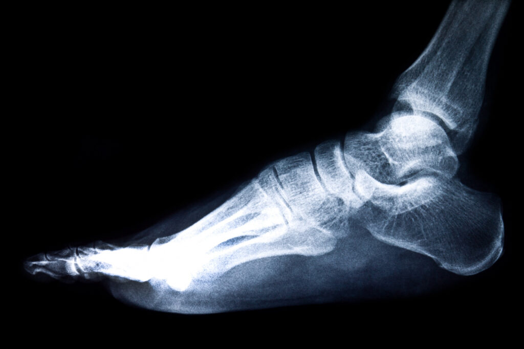 Lateral-view-x-ray-of-a-human-foot-showing-bones-and-joints-in-detail